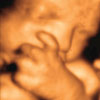 3D Ultrasound Image
