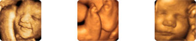 StorkVision 3D Ultrasound images
